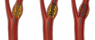 Хирургическое лечение бессимптомных стенозов и окклюзий сонных артерий. За и против  