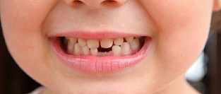 Сроки прорезывания молочных зубов