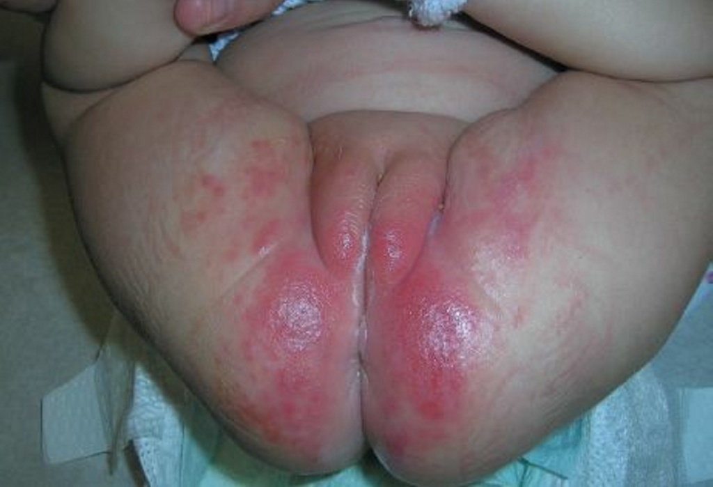 Пеленочный дерматит осложненный кандидозом фото thumbnail