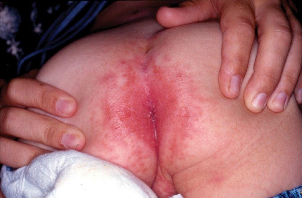 Пеленочный дерматит опрелость лечение thumbnail