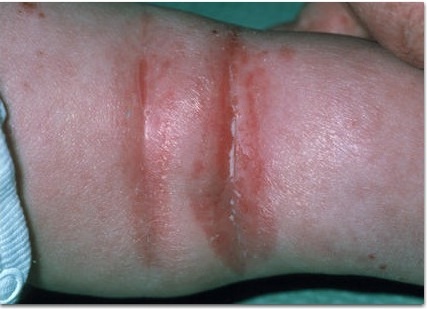 атопический дерматит тяжелое течение лечение thumbnail
