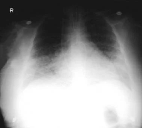Описание рентгенограммы при пневмонии нижнедолевой thumbnail