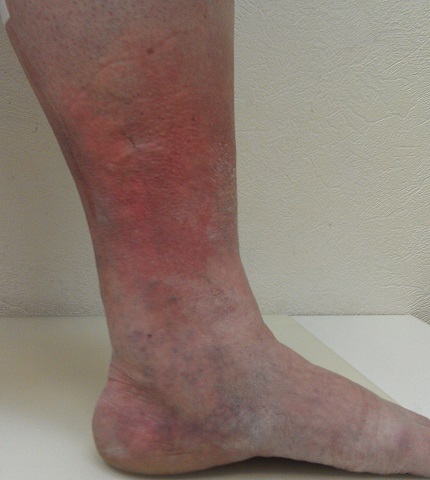 Цвет кожи ног лечение thumbnail