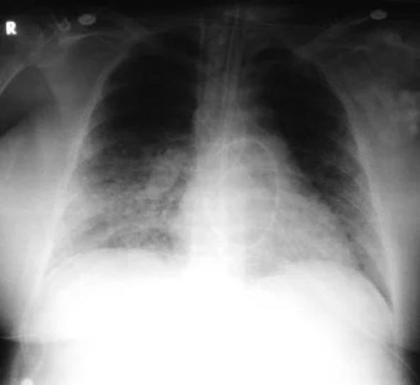 Рентгенография грудной клетки после пневмонии thumbnail