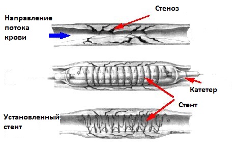 Лечение после стентирования