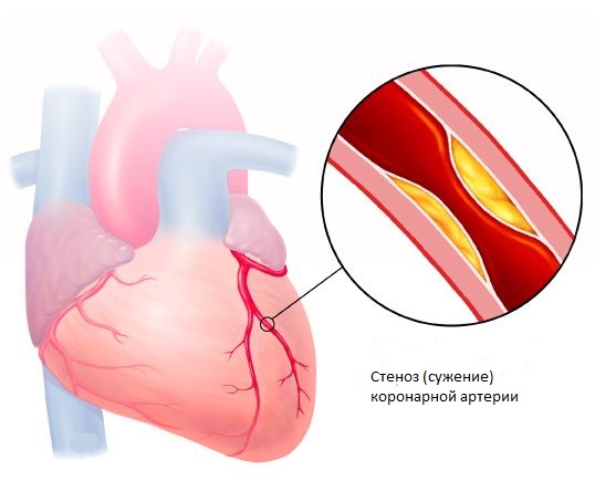 коронарный стеноз