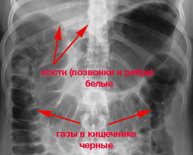 обзорный рентген брюшной полости