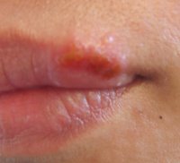 Как лечат герпес на губах и какие средства применяют?