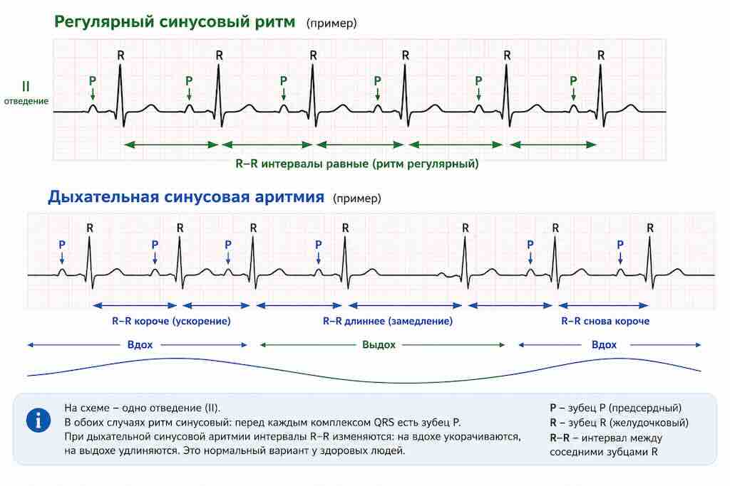 Регулярный синусовый ритм и дыхательная синусовая аритмия на ЭКГ