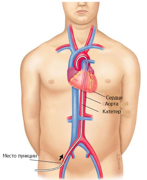 коронарография, катетер в просвете аорты, пункция бедренной артерии