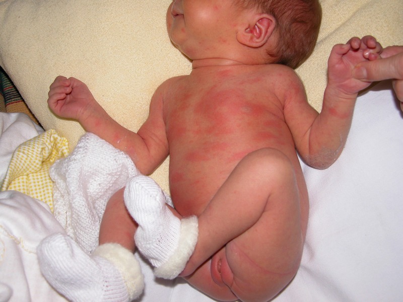 Сыпь у детей, токсическая эритема, у новорожденных