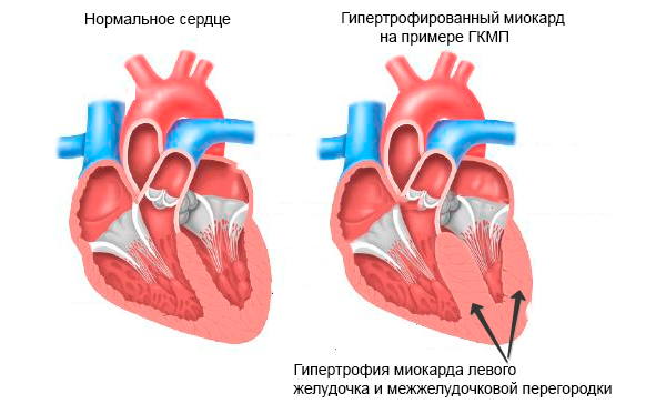 ГКМП, гипертрофическая кардиомиоматия