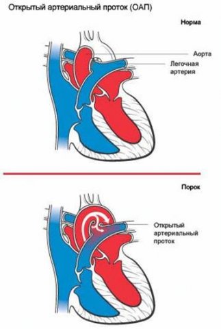 Эндоваскулярное закрытие открытого артериального протока с помощью окклюдера