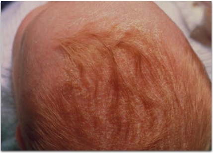 Сыпь у детей, себорейный дерматит, себоррейный дерматит, на лице, на голове, на волосистой части головы, молочный струп