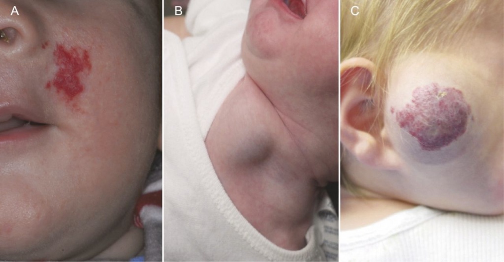 Лечение гемангиом и сосудистых образований у детей