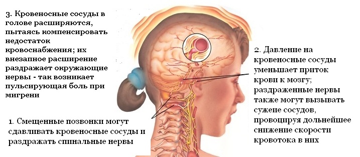 Мигрень: симптомы и причины возникновения частой головной боли