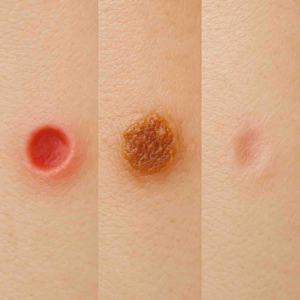 Фотографическая медицинская иллюстрация: три стадии одного и того же участка кожи — язва, язва с коркой и рубец. Наглядная динамика заживления вторичных элементов сыпи.