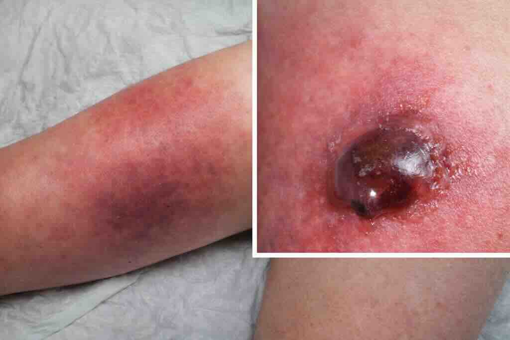 Двухпанельная иллюстрация некротизирующей инфекции мягких тканей: разлитая эритема и отёк конечности с переходом в тёмно-пурпурный оттенок; на крупном плане — геморрагическая булла как один из настораживающих признаков тяжёлого процесса.