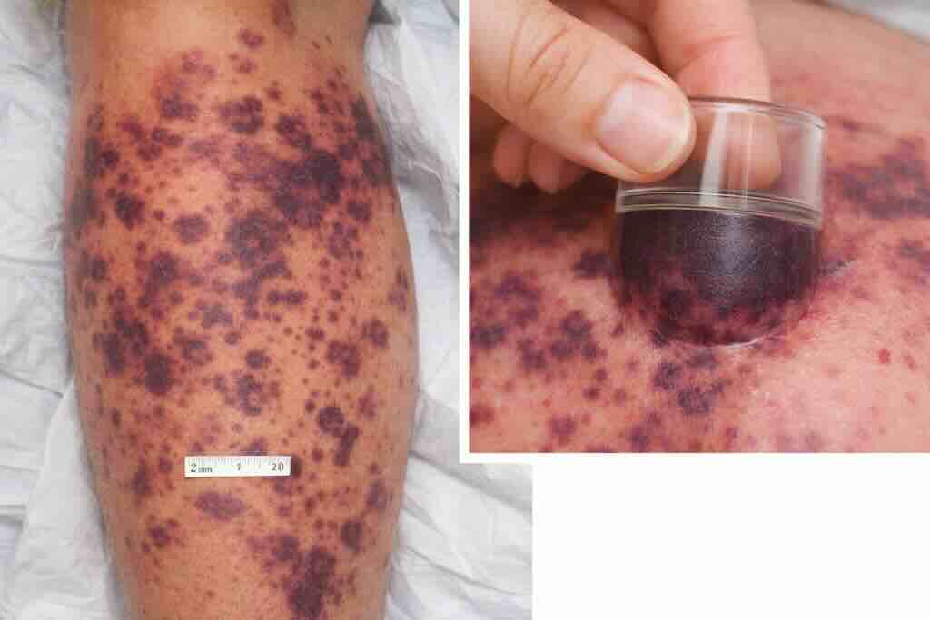 Двухпанельная иллюстрация purpura fulminans: множественные небледнеющие геморрагические элементы (петехии/экхимозы), часть >3 мм, с быстрым распространением. На крупном плане показана диаскопия: при надавливании прозрачным предметом элементы не исчезают, что подтверждает пурпуру.