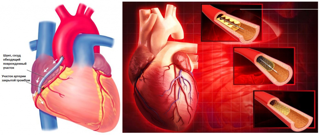 акш и стентирование