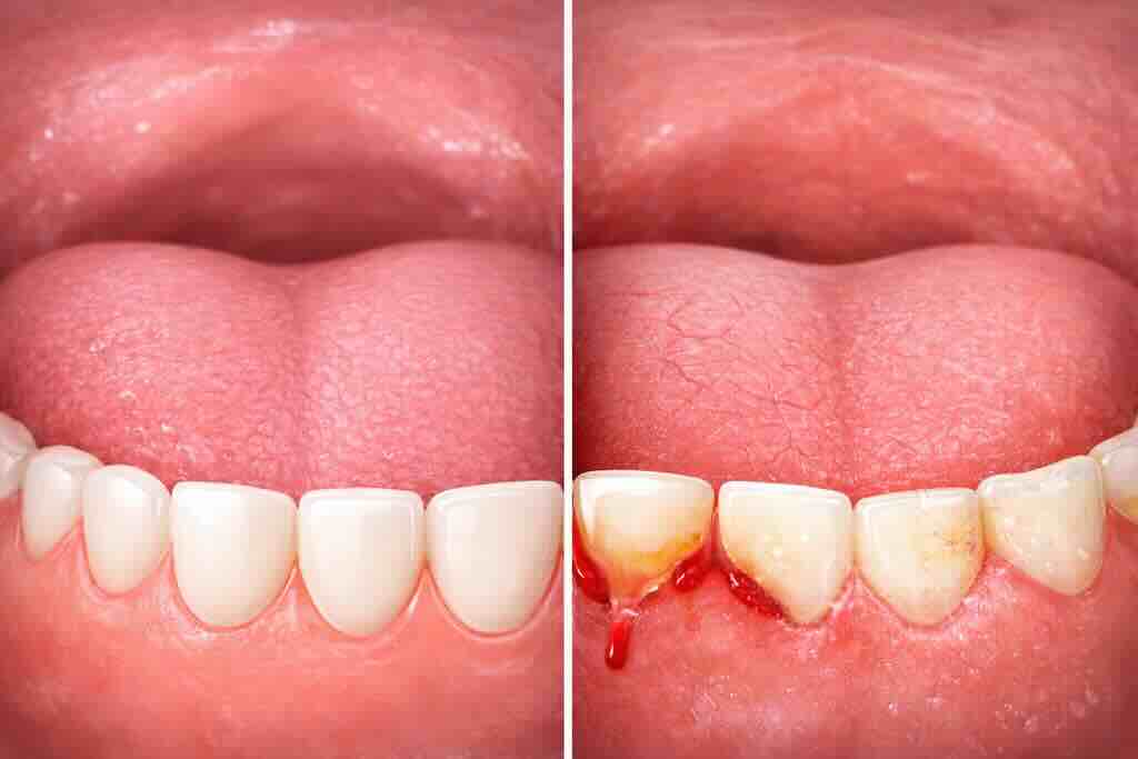 Слева — условно здоровая картина. Справа — пример того, как сухость во рту может сочетаться с налётом, раздражением дёсен и признаками повреждения эмали.