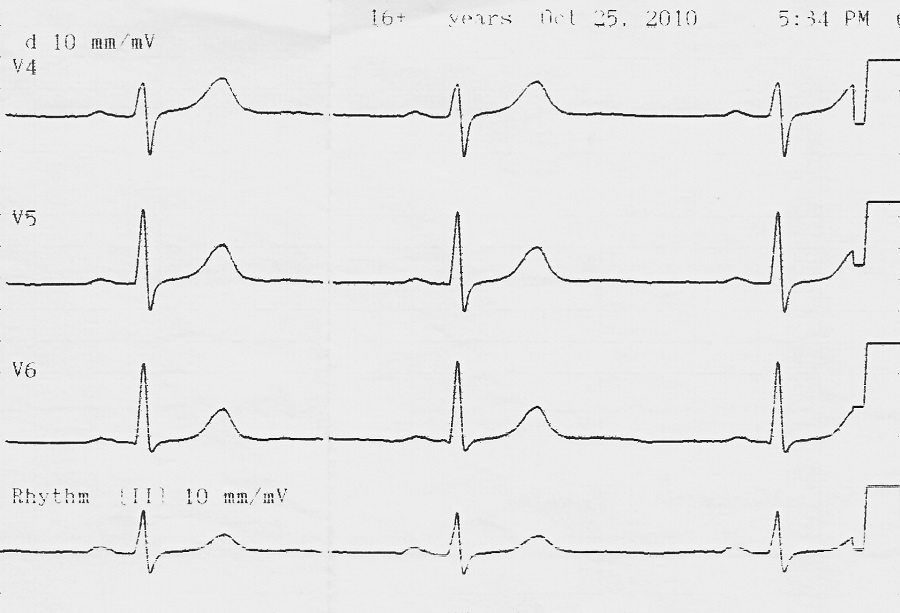 Экг, электрокардиограмма, кардиограмма, ЧСС-60 в минуту. Ритм синусовый, правильный. PQ-0,14 сек.,QRS-0,08 сек.,QT-0,40 сек. Поворот сердца вокруг продольной оси по часовой стрелке, переходная зона смещена в отведение V4