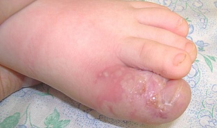 Герпетический панариций. Четвертый день болезни