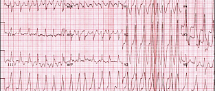 Фибрилляция предсердий. Факторы риска и динамика заболевания