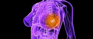 Типы рака молочной железы. Влияние на выживаемость и прогноз