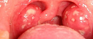 Рецидивирующие стрептококковые ангины