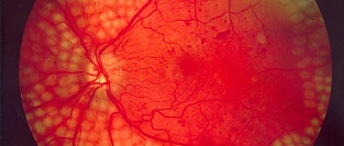 Омега-3 и риск диабетической ретинопатии