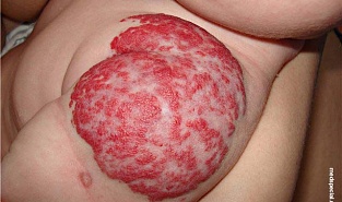 Гемангиома