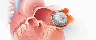 Окклюзирование ушка левого предсердия (ОУЛП) при фибрилляции предсердий. Разбор исследования LAAC-REFUSAL
