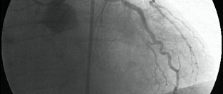Незначимые поражения коронарных артерий и частота инфарктов миокарда