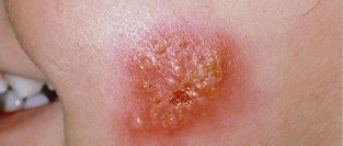 Импетиго (стафилодермия, стрептодермия). Описание элементов сыпи.