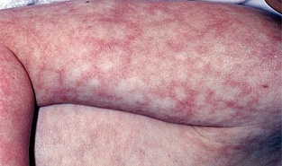 Мраморная кожа