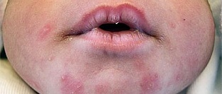 Токсическая эритема новорожденных. Описание элементов сыпи.