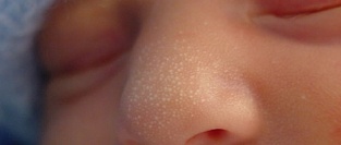 Милии. Описание элементов сыпи.