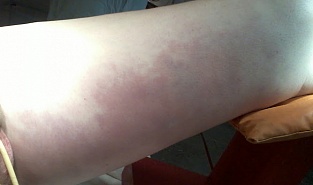 Некротизирующий фасциит. Внешние проявления