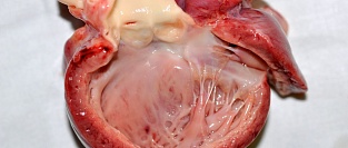 Инфекционный эндокардит. Рекомендации и заболеваемость