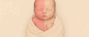 Симптом раскраски Арлекина (феномен Арлекина) у новорождённых: фото и описание изменений кожи