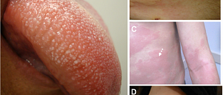 Анафилаксия. Обзор для врачей