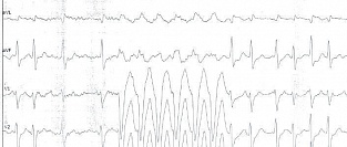 Фибрилляция предсердий. О причинах смерти