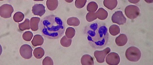 Нейтропения у детей