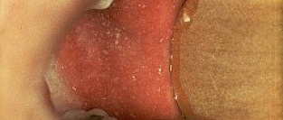 Корь. Описание элементов сыпи.