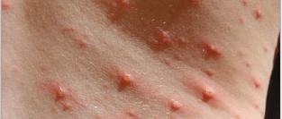 Ветрянка. Об эффективности вакцинации