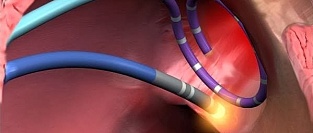 Катетерная аблация фибрилляции предсердий. Влияние на продолжительность жизни