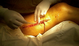 Некротизирующий фасциит. Фасциотомия