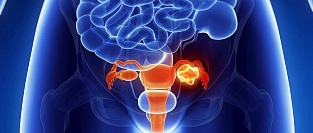 Рак яичников. Исследование эффективности скрининга