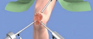Артроскопическая хирургия коленного сустава при дегенеративных заболеваниях. Соотношение риск-польза